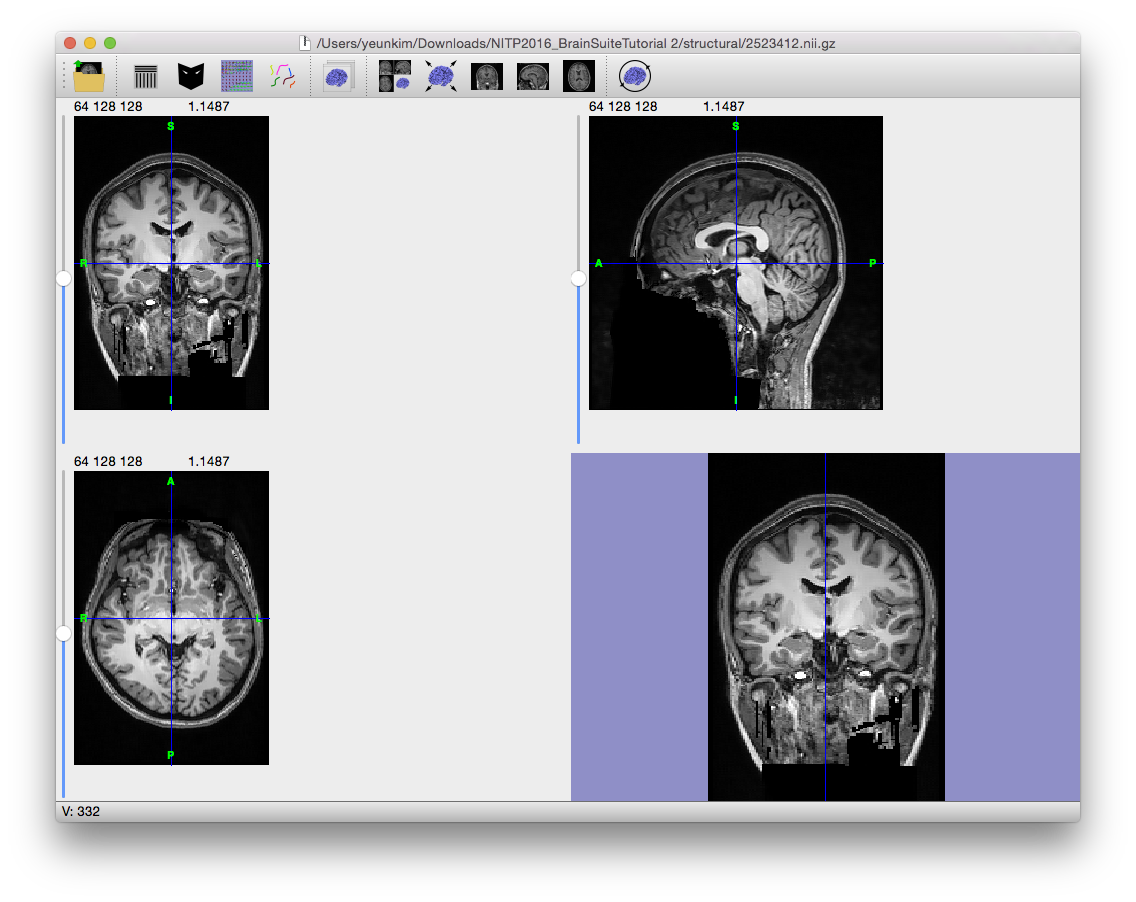 An MRI after processing with an anisotropic diffusion filter.