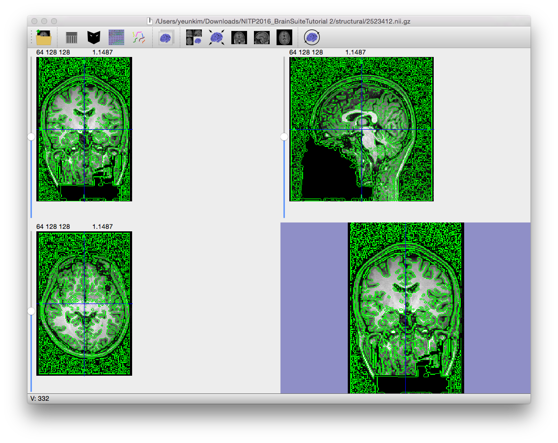 The result of applying the edge detector operator to an MRI.
